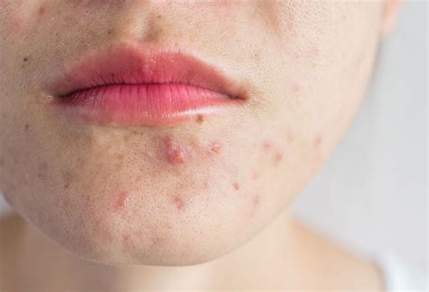 How What You Eat Affects Your Skin | The Well by Northwell