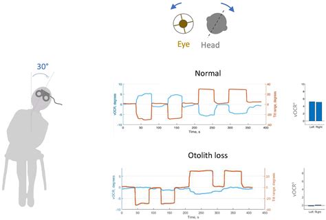 Focused Update on Clinical Testing of Otolith Organs