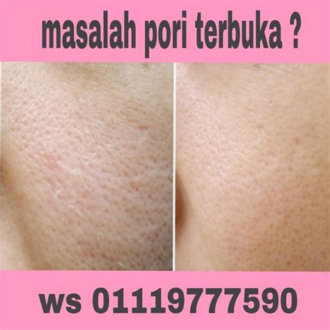 cara hilangkan panu di wajah