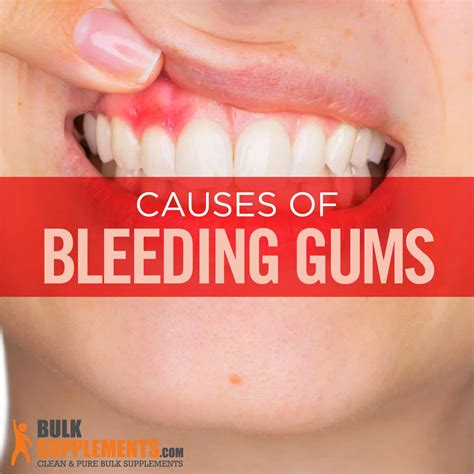 How To Avoid Bleeding Gums
