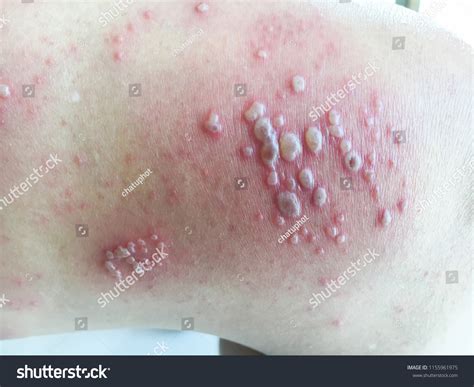 Herpes On Thighs Only