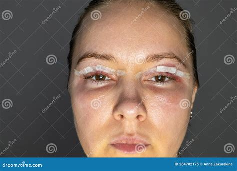 Woman Face after Plastic Surgery, Blepharoplasty Operation, Swelling Eye Bags, Incisions with ...