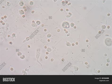 Red Blood Cells And White Blood Cells In Urine