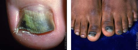 Psoriasis Toenails