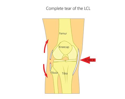 Grade 2 Ligament Tear Knee Recovery Time : Mcl Sprain Symptoms ...