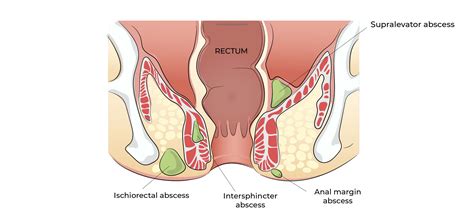 Ischiorectal Abscess Perianal Abscess Stock Image M108/0682