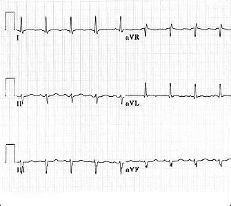 The Normal ECG