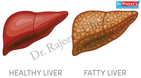 Dr. Rajeev Clinic: Renowned Homeopathic Treatment for Fatty Liver