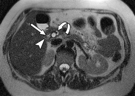 Annular Pancreas Radiopaedia