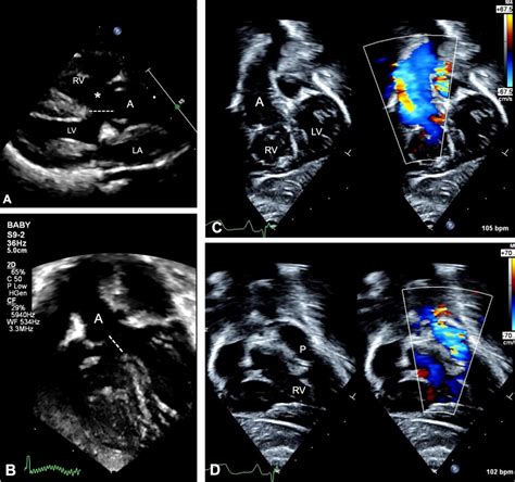 Double outlet ventricles: review of anatomic and imaging ...