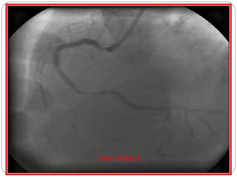 Left ventricular aneurysm | PPT