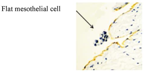 The Development of Peritoneal Metastasis from Gastric Cancer and ...