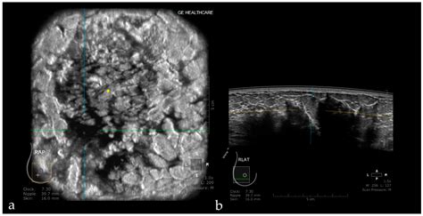 Pros and Cons for Automated Breast Ultrasound (ABUS): A Narrative Review