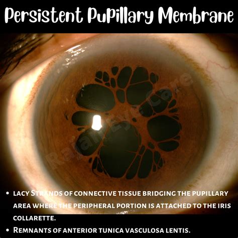 Persistent Pupillary Membrane — Ophthalmobytes