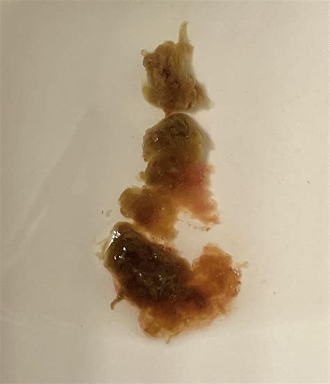 Stringy Mucus In Stool