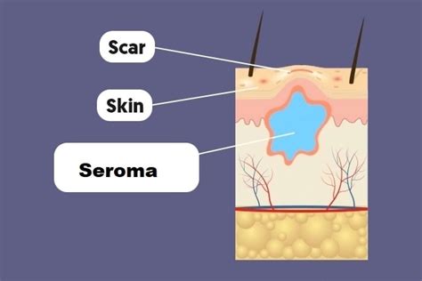 What Is A Seroma