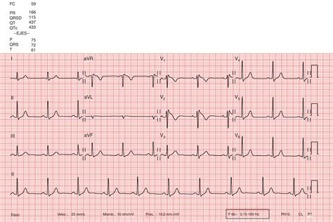 Síndrome de Brugada: puesta al día | Cardiocore