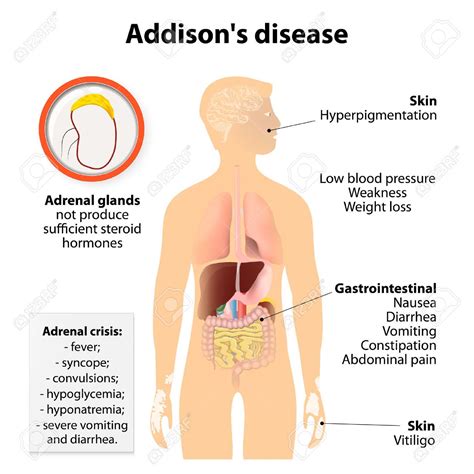 MORBO di ADDISON Cause. Ca. il 70% dei casi del m. di Addison negli USA, è dovuto ad atrofia ...