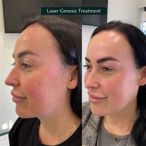 Excel V Laser For Rosacea at Micheal Weston blog