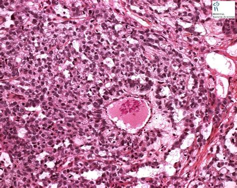 Schiller-Duvall body - Humpath.com - Human pathology