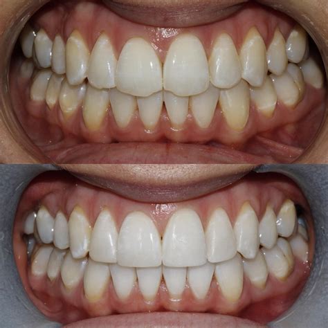 Composite Bonding | Newcastle | Dentist | Honour Health