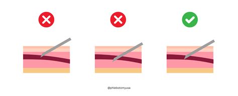 Bruises After Blood Donation