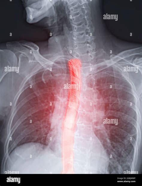 Esophageal Ulcer