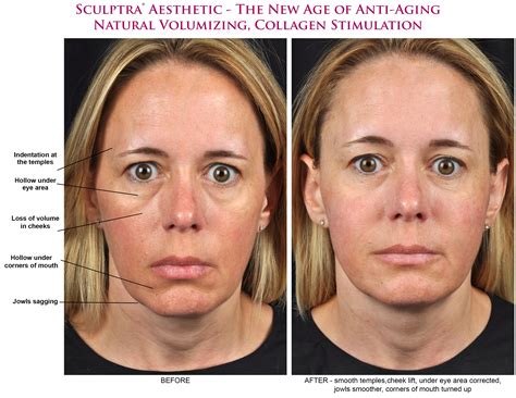 Sculptra Aesthetic Natural Volumizing Collagen Stimulation | Sculptra aesthetic, Sculptra ...