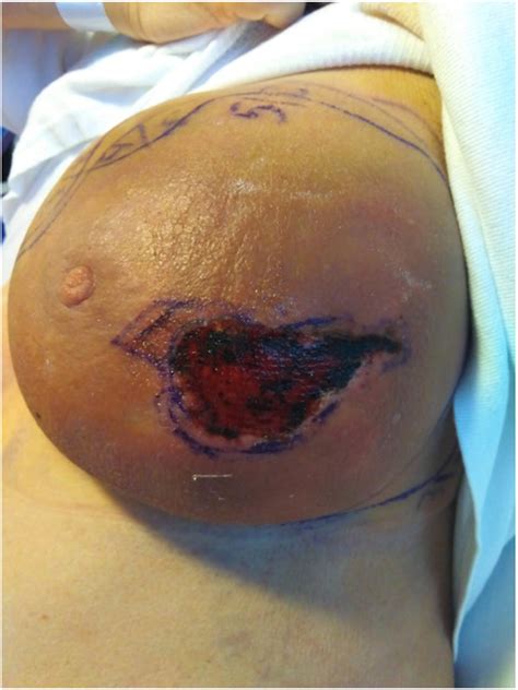 Spontaneous breast haemorrhagic necrosis: A case report - Lina Pankratjevaite, Katrine Lind ...