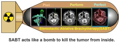 JPM | Special Issue : Application of Brachytherapy in Clinical Practice