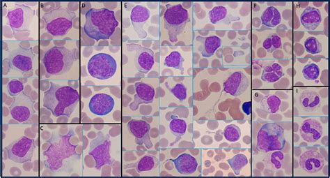 Mononucleosis Skin Rash