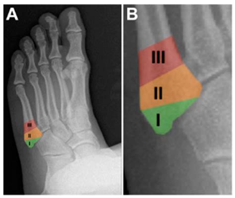 Pseudo Jones Fracture