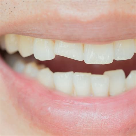Have a Chipped Tooth? Here’s What to Do Right Away
