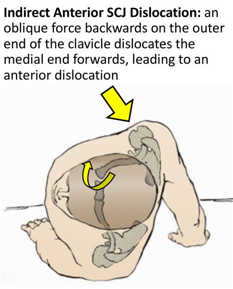Anterior Shoulder Dislocation Mechanism Of Injury