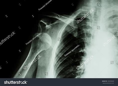 X Ray Features Of Anterior Shoulder Dislocation at Courtney Menard blog
