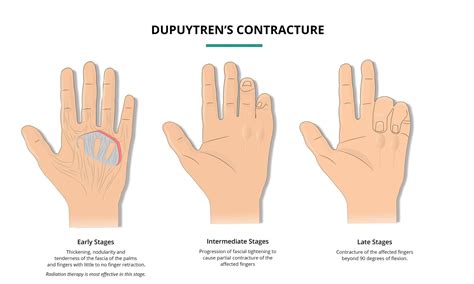 Dupuytren Contracture Pictures Dupuytren Contracture Dupuytren's