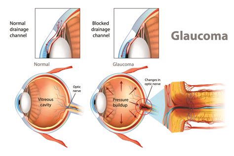 How I Cured My Glaucoma