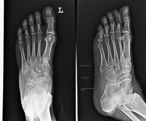 Avulsion Fracture 5Th Metatarsal Xray at Jose Watson blog