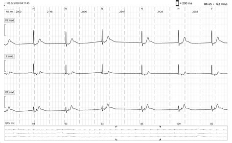 Junctional Bradycardia Rhythm Strip