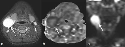 Shotty retroperitoneal lymph nodes - tyredmorning