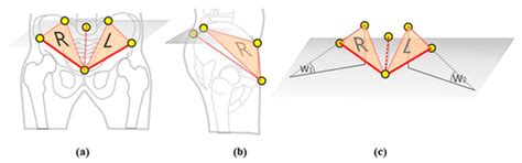 Impact of Quadriceps/Hamstrings Torque Ratio on Three-Dimensional ...