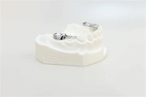 Get Custom Dental Spacers for Children in Palo Alto, CA