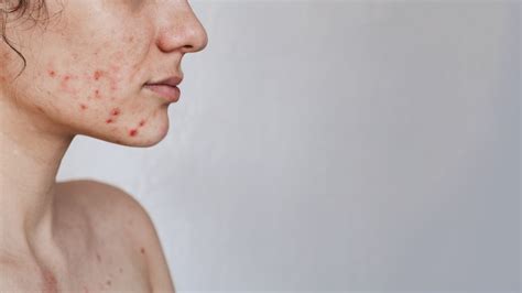 Doxycycline for Acne: How It Works & Its Effects