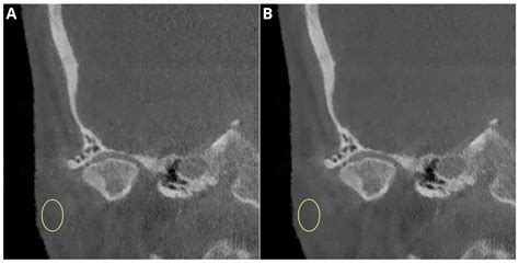 Mri Blooming Artifact Tmj