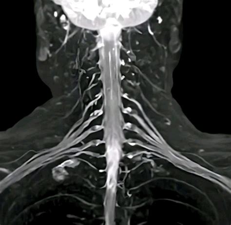 🧠💡 | Brachial Plexus MR Neurography 🚀 | Advanced Imaging with 3D… | Abanoub Fahmy
