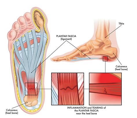 Strategies for Healing Plantar Fascia Tears – GatsbyShoes