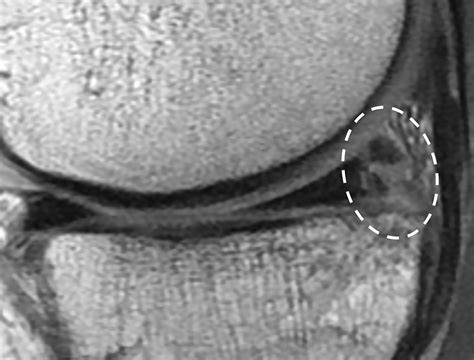 Mri Knee Medial Meniscus Tear