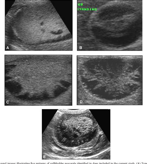 gallbladder rupture | Semantic Scholar