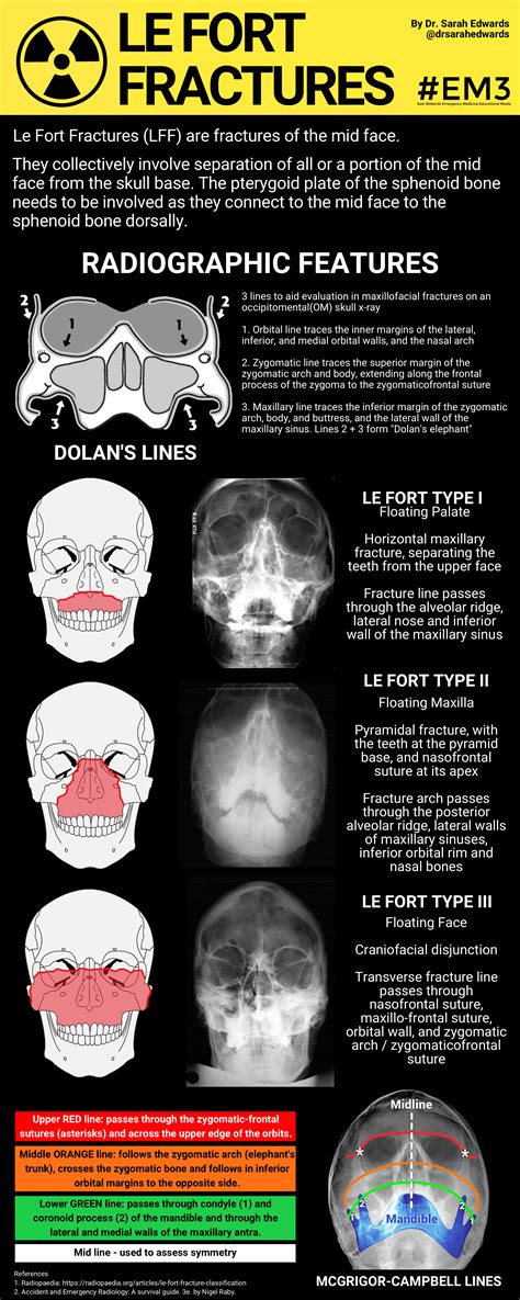 Le Fort Fracture X Ray How To Simplify The CT Diagnosis Of Le Fort