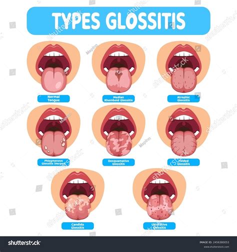 Illustration Oral Infection Disease Glossitis Great Stock Vector (Royalty Free) 2456380053 ...